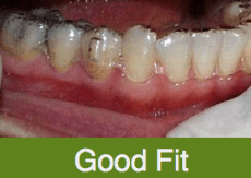 open mouth with well-fitting dental aligner