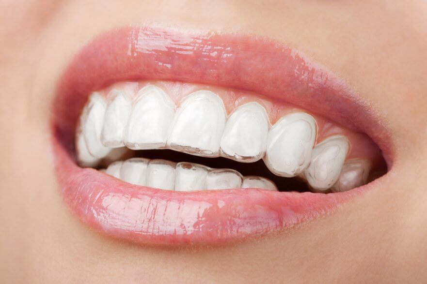 close up of woman's mouth wearing clear dental aligner
