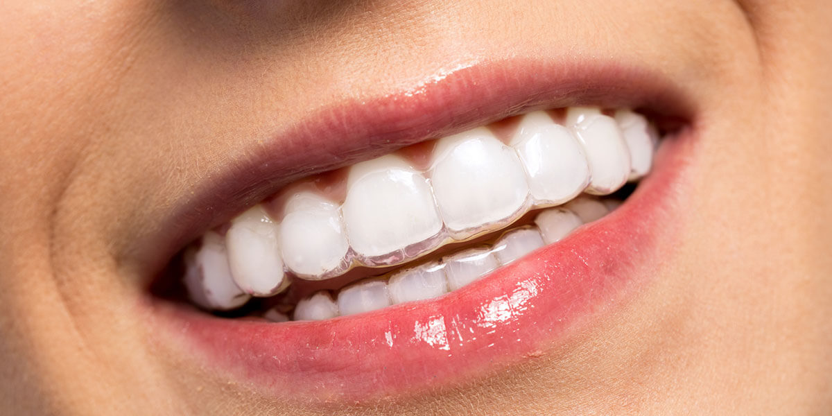 close up of woman's mouth wearing clear dental aligner