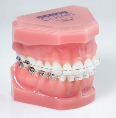 model of teeth with damon clear braces
